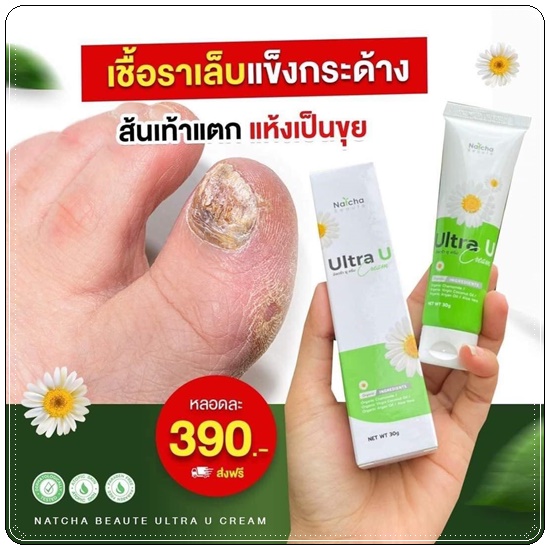อัลตร้า ยู ครีม Ultra U Cream Natcha ลดอาการคัน กลากเกลื้อน