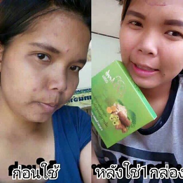 ครีมสมุนไพรมหัศจรรย์ บีเฮิร์บ (B Herb) สูตรใหม่