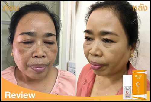 เซรั่มวิตซี สลายฝ้า มารีแอน Mary Ann (โปรส่งฟรี)