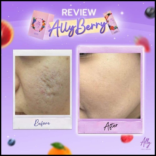 Ally Berry Collagen แอลลี่ เบอร์รี่ คอลลาเจน
