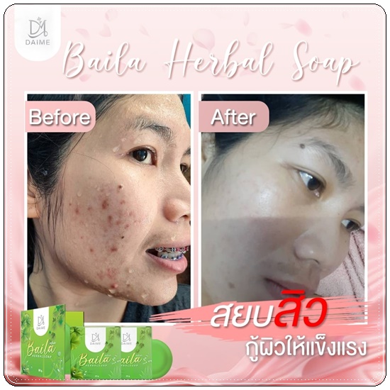 สบู่ใบล่า Baila Herbal Soap DAIME