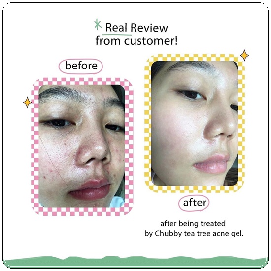 เจลแต้มสิวชับบี้ Chubby Tea Tree Acne Gel