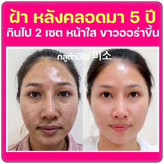 กลูต้ามีโซ Meeso Gluta (1แถม1)