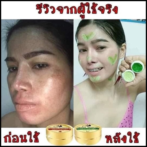 IRish White + Mira Serum เซตรักษาสิว ผิวขาวใส