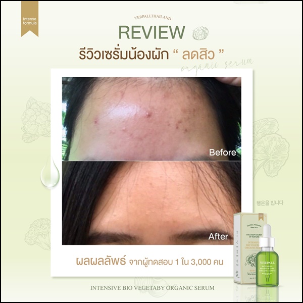เซรั่มผัก ลดสิว Yerpall