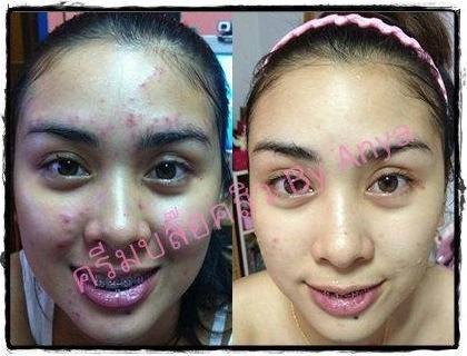 ครีมบล็อคสิว (skincare by anya)