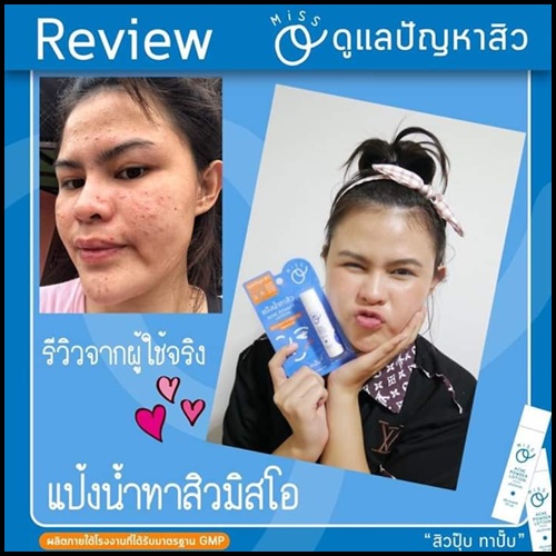 แป้งน้ำทาสิว มิสโอ Miss O Acne Powder Lotion