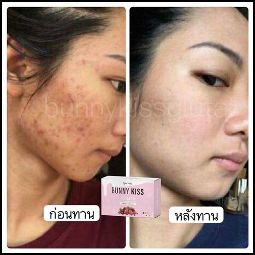 บันนี่คิสกลูต้า Bunny Kiss Gluta