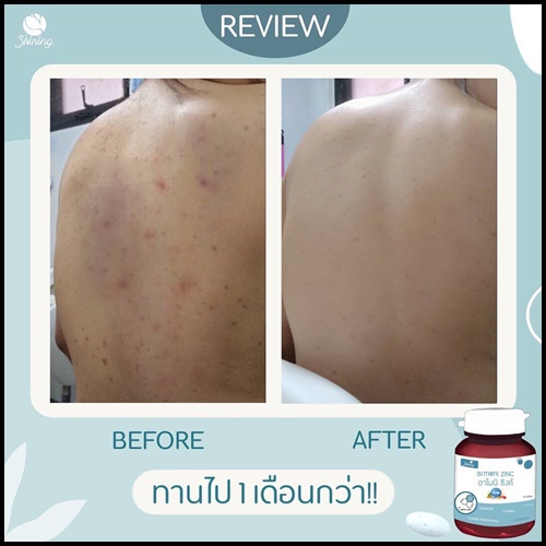 อาโมนิซิงค์ Amoni Zinc ลดสิว