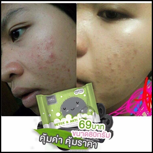 ใหม่ สบู่คลีนซิ่ง ดีท็อกซ์เอมิ Detox & Anti Acne By Ami Skincare