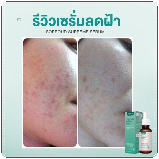 เซรั่มสลายฝ้า Soproud Supreme Serum deproud (ส่งฟรี)
