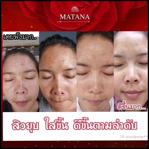 เซรั่มมัทนา Matana Angel Rose Drop Serum เซรั่มหยดกุหลาบนางฟ้า ของแท้ (ส่งฟรี)