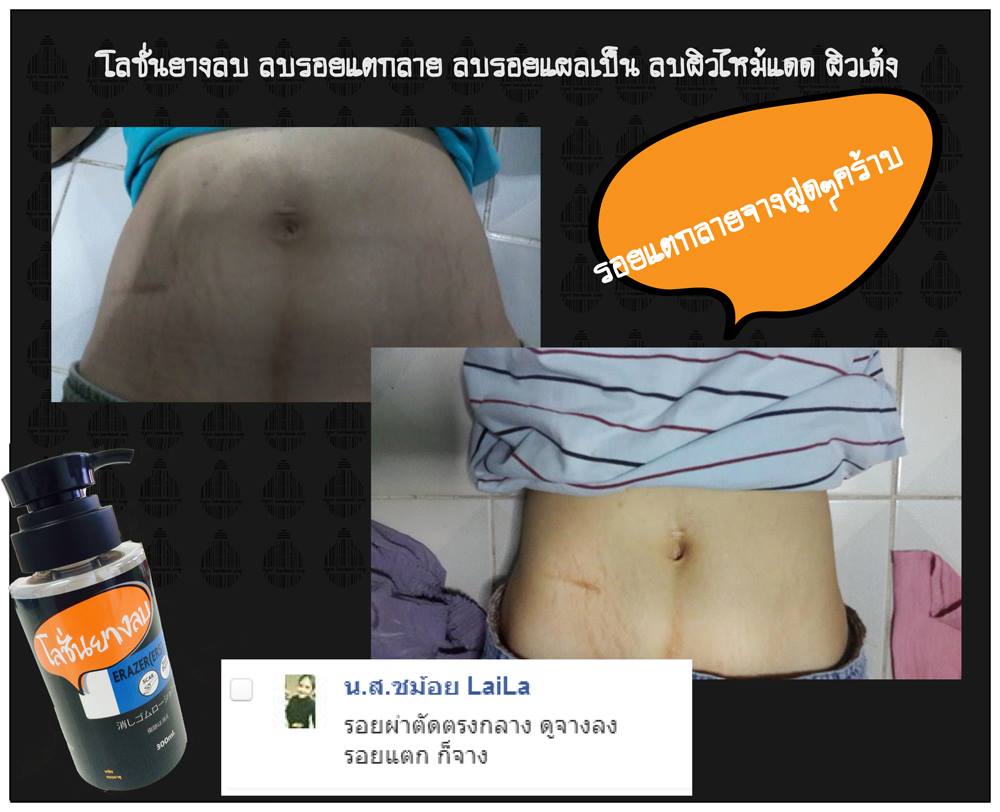 โลชั่นยางลบ by Hiper