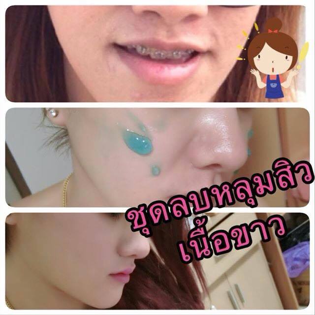 ชุดครีมลบหลุมสิว By Punlapa