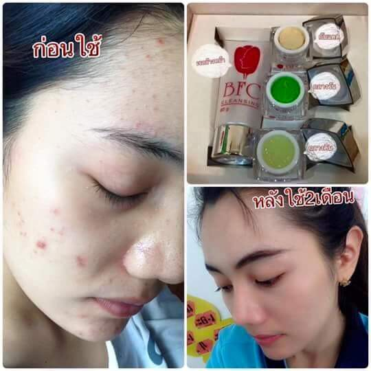 ครีม BFC Baby Face Cream ครีมหน้าใสรักษาสิว