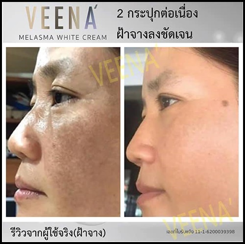 วีน่า เมลาสมา ไวท์ ครีม VEENA Melasma White Cream