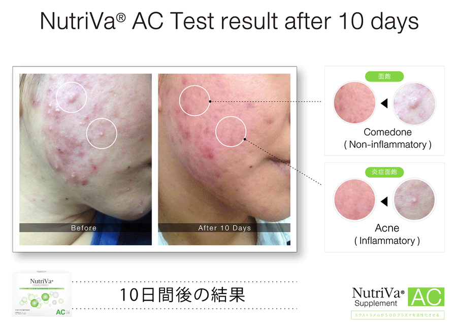 นูทริว่า เอซี ฟอร์ แอคเน่ (Nutriva AC For Acne)