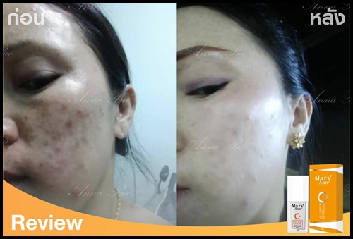 เซรั่มวิตซี สลายฝ้า มารีแอน Mary Ann (โปรส่งฟรี)