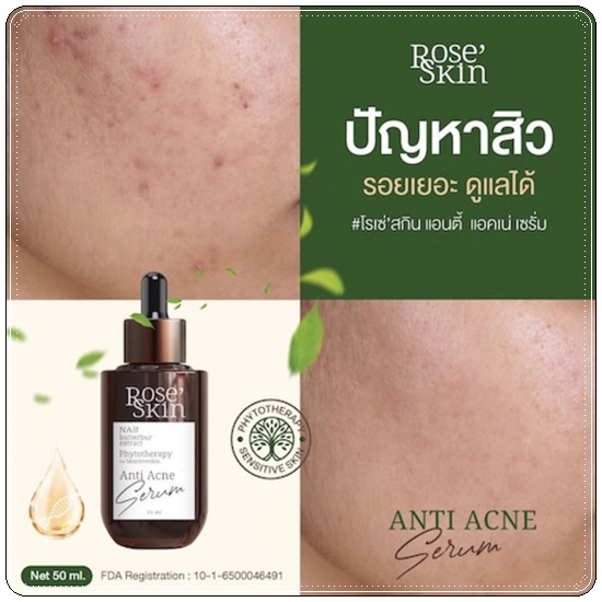 เซรั่มลดสิว โรเซ่สกิน Rose' Skin Anti Acne Serum