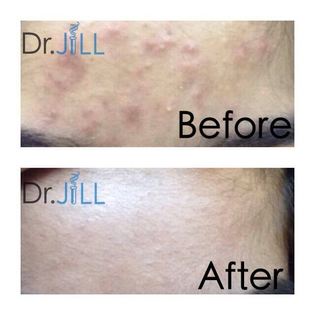 เซรั่ม Dr.Jill G5 Essence เซรั่มครีม แพท ณปภา โปรส่งฟรี EMS