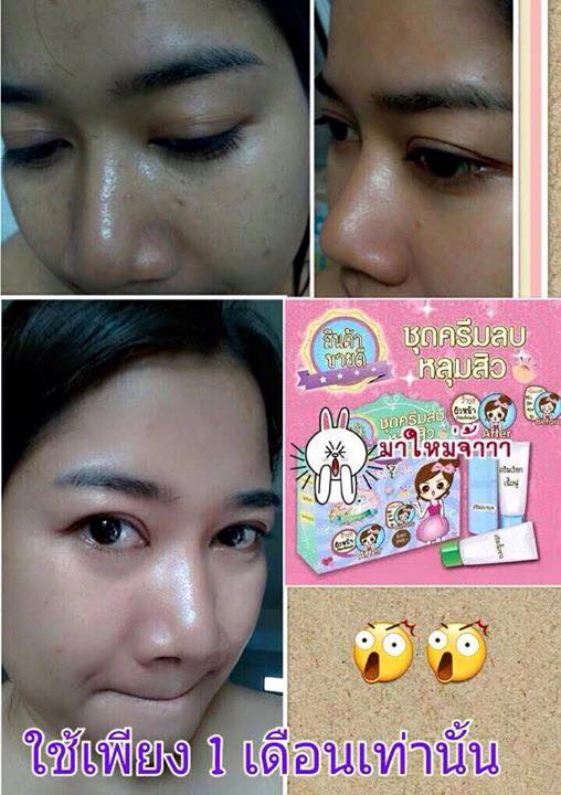 ชุดครีมลบหลุมสิว By Punlapa