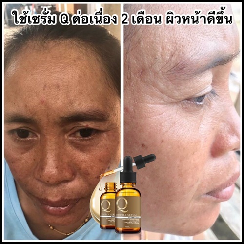 เซรั่ม Q Double Serum เซรั่มสลายฝ้า หน้าเด็ก (ของแท้ ส่งฟรี)
