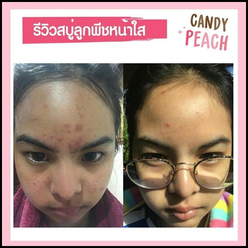 สบู่ลูกพีชหน้าใส แคนดี้พีช Candy Peach