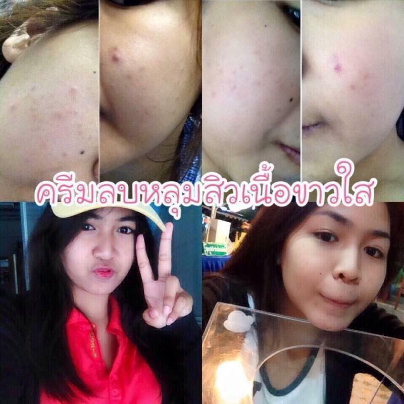 ชุดครีมลบหลุมสิว By Punlapa