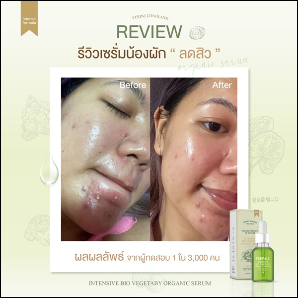 เซรั่มผัก ลดสิว Yerpall