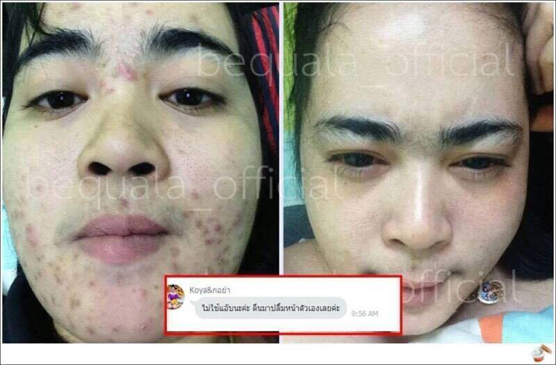 ครีมบีควอล่า(bequala) เซตเปลี่ยนหน้าสิวให้เป็นหน้าใส โปรฟรี EMS