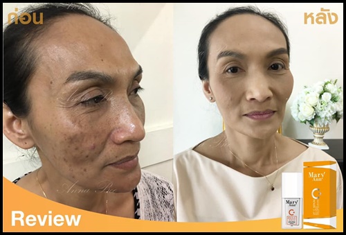 เซรั่มวิตซี สลายฝ้า มารีแอน Mary Ann (โปรส่งฟรี)