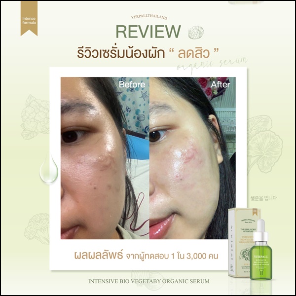 เซรั่มผัก ลดสิว Yerpall