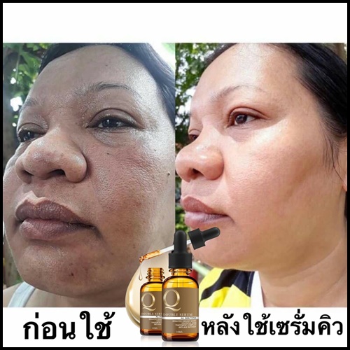 เซรั่ม Q Double Serum เซรั่มสลายฝ้า หน้าเด็ก (ของแท้ ส่งฟรี)