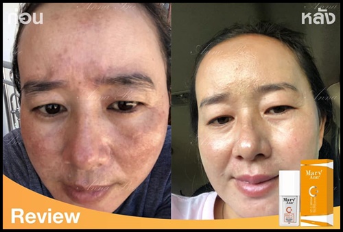 เซรั่มวิตซี สลายฝ้า มารีแอน Mary Ann (โปรส่งฟรี)