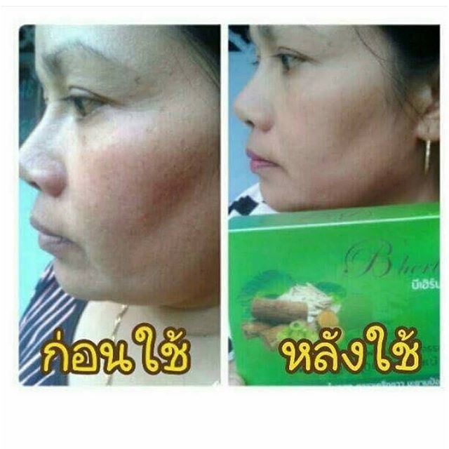 ครีมสมุนไพรมหัศจรรย์ บีเฮิร์บ (B Herb) สูตรใหม่
