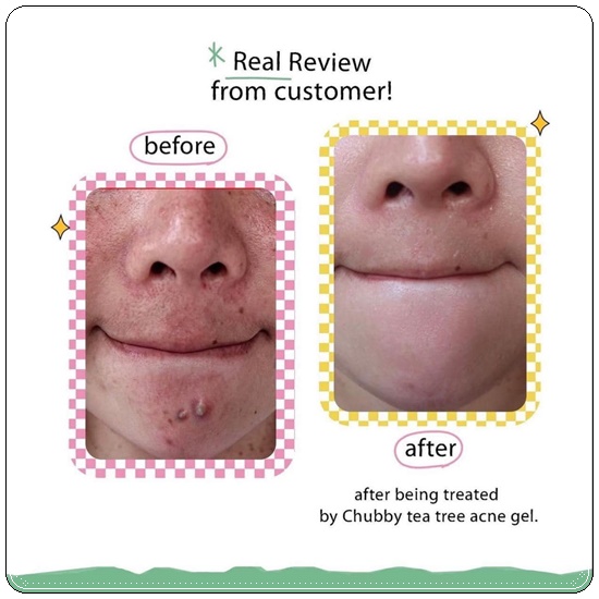 เจลแต้มสิวชับบี้ Chubby Tea Tree Acne Gel