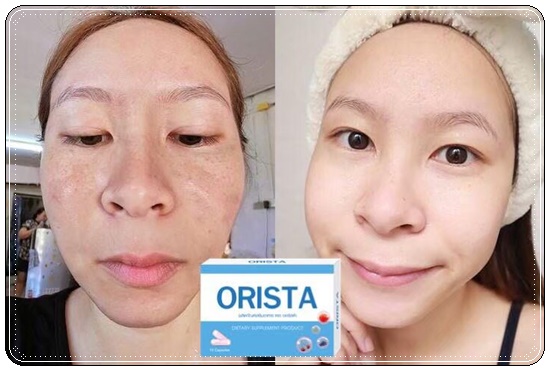 ออริสต้าพลัส ORISTA Plus สูตรใหม่ วิตามินรักษาฝ้า