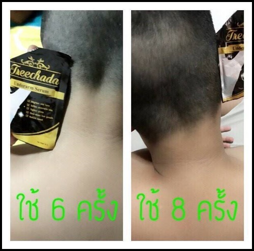 เซรั่มรักแร้ ตรีชฎา Treechada Underarm Serum