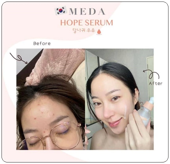 MEDA HOPE Serum Donke Milk เซรั่มน้ำนมลา (ของแท้ ส่งฟรี)