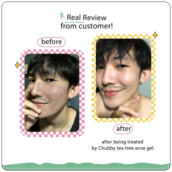เจลแต้มสิวชับบี้ Chubby Tea Tree Acne Gel