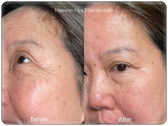 แฮวอนไฮยาฟิลเลอร์ HYA Filler Serum HAEWON ฟิลเลอร์แบบทา (ส่งฟรี)