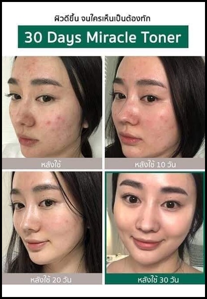 AHA-BHA-PHA 30 Days Miracle Starter Kit ชุดบำรุงผิวหน้า สำหรับผู้ที่มีปัญหาสิวโดยเฉพาะ