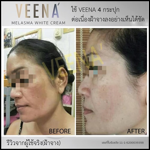 วีน่า เมลาสมา ไวท์ ครีม VEENA Melasma White Cream