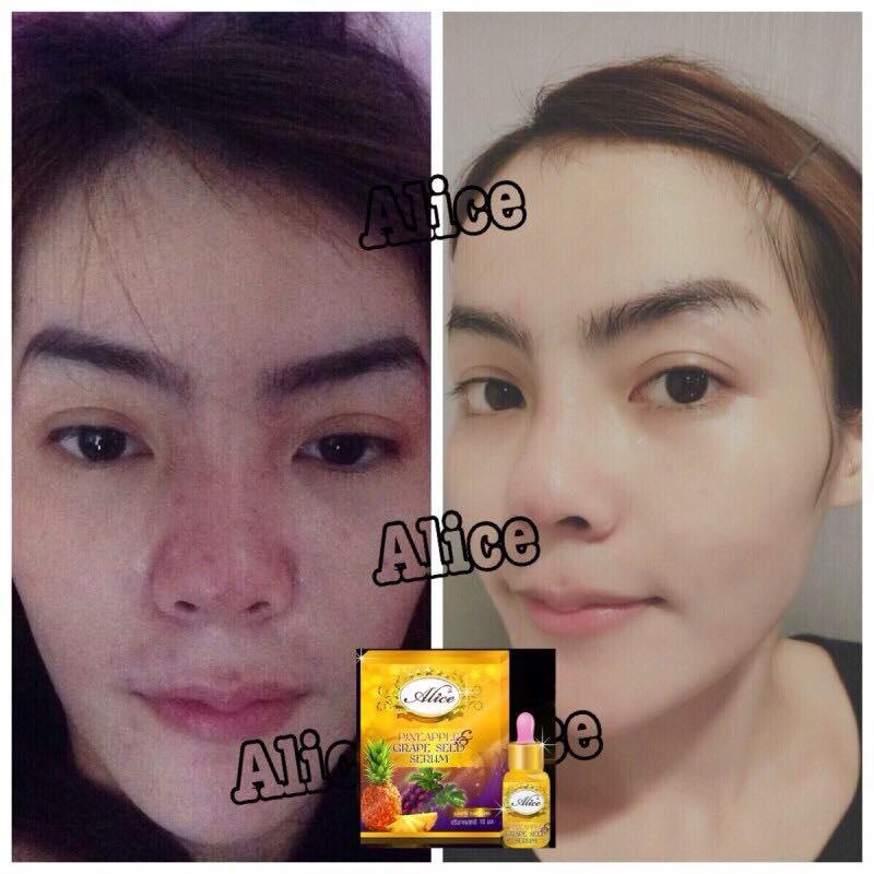 เซรั่มสับปะรด&องุ่น (เซรั่มเทพหน้าใส Pineapple & Grape Seed Serum)