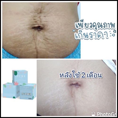 เพียว ครีมทารักแร้ขาว PURE Underarm Treatment Smooth (แพ็คเก็จใหม่)