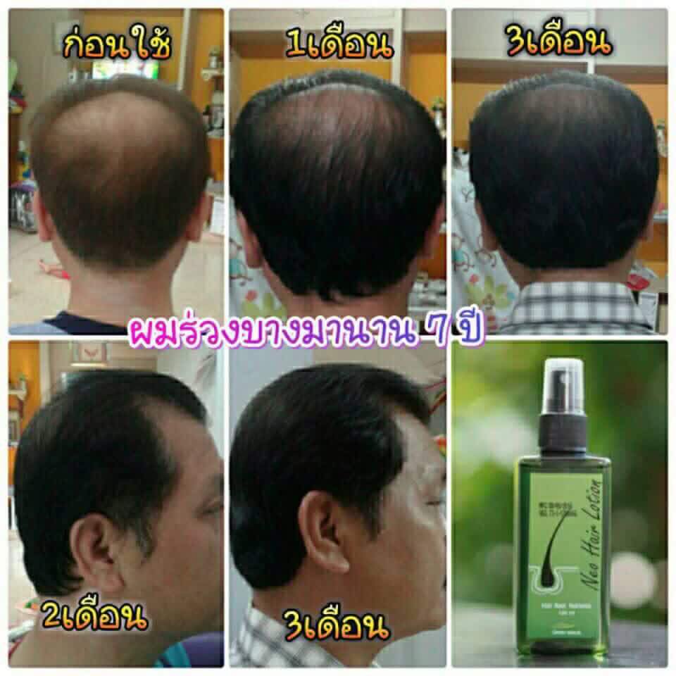 นีโอแฮร์สเปรย์ โลชั่นปลูกผม Neo Hair Lotion Hair Root Nutrients