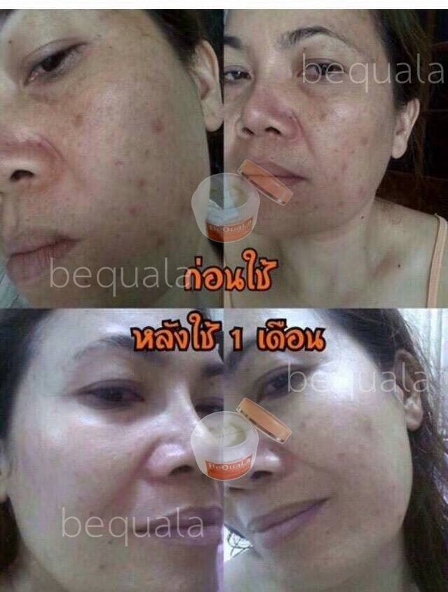 ครีมบีควอล่า(bequala) เซตเปลี่ยนหน้าสิวให้เป็นหน้าใส โปรฟรี EMS