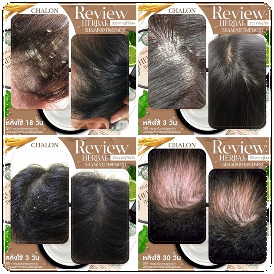 แชมพูมะกรูดชลอน Chalon Herbal Shampoo (แถมฟรี ทรีทเม้นชลอน)