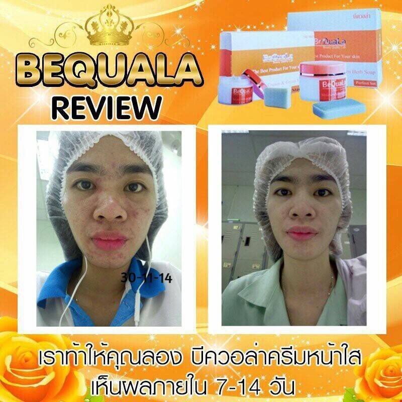 ครีมบีควอล่า(bequala) เซตเปลี่ยนหน้าสิวให้เป็นหน้าใส โปรฟรี EMS