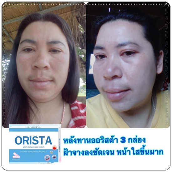 ออริสต้าพลัส ORISTA Plus สูตรใหม่ วิตามินรักษาฝ้า